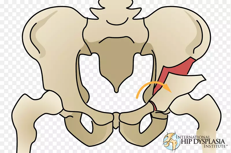 截骨术髋关节发育不良髋臼股骨骨