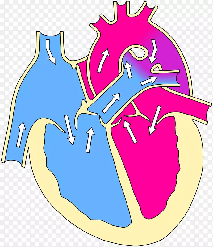 法洛室间隔缺损的四联症先天性心脏缺损动脉导管未闭-心脏病发作