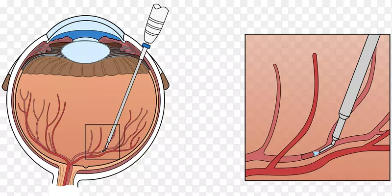 视网膜中央静脉阻塞血管阻塞解剖
