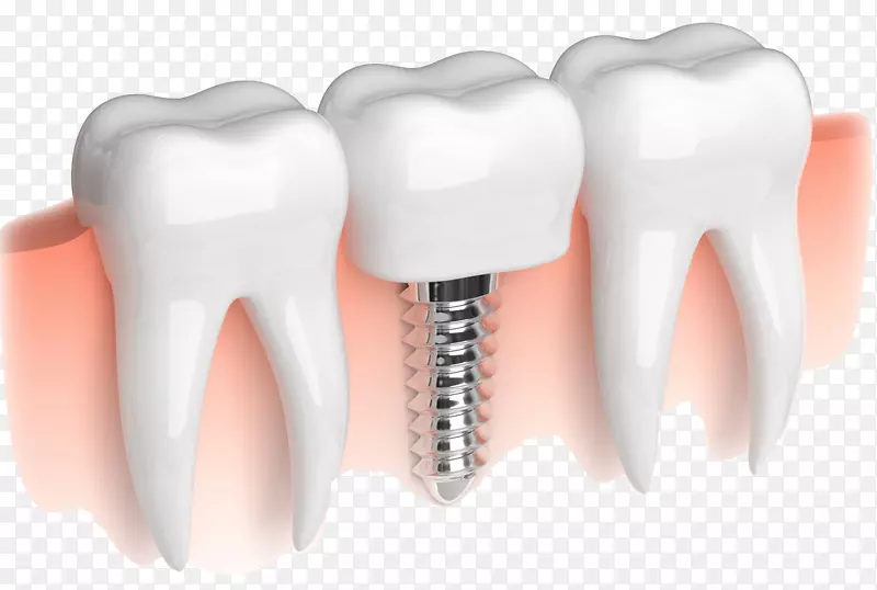 牙科种植义齿桥式溶解