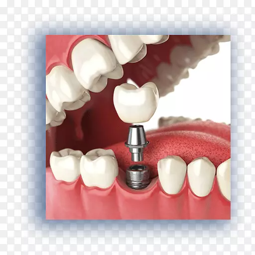 牙种植体牙科牙齿缺失种植体