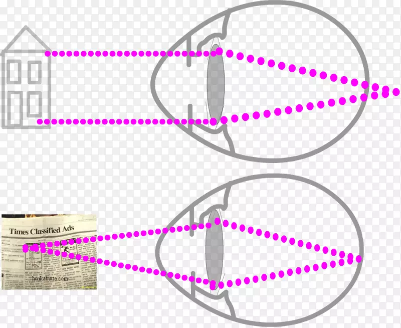近视眼视觉知觉LASIK远视眼-光辐射