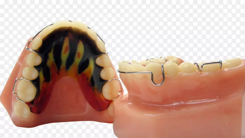 牙颌固位器正畸Roa-理光正畸矫治器