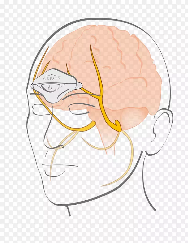脑三叉神经刺激偏头痛电极神经