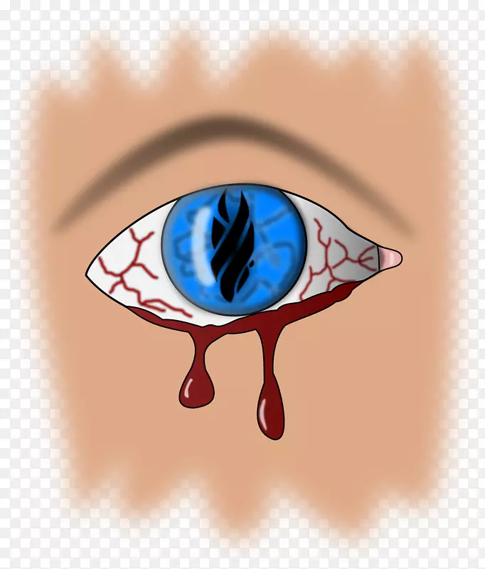 眼出血心脏视网膜出血夹术