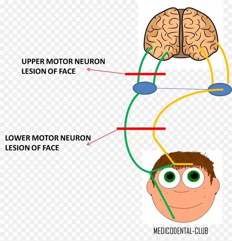 下运动神经元损伤面神经上运动神经元损伤颅神经