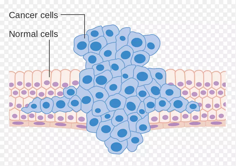 癌细胞转移瘤-各种癌细胞