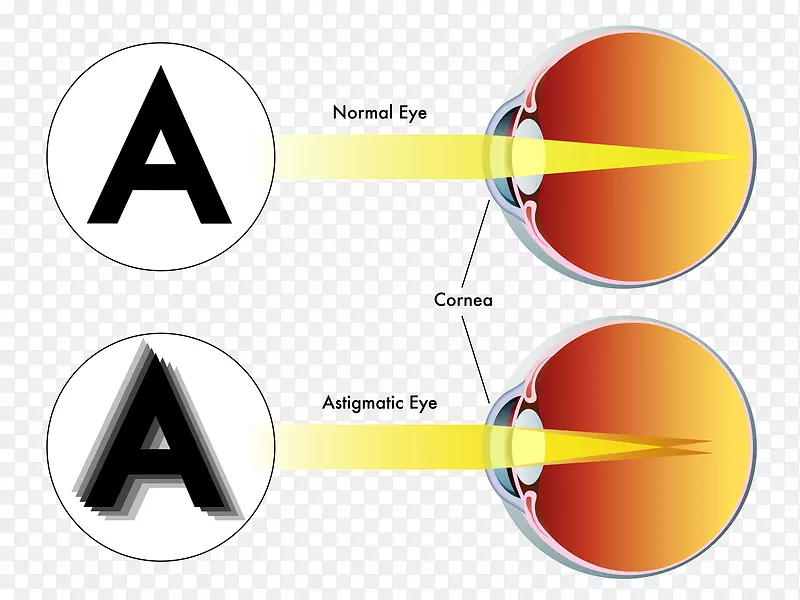 LASIK散光屈光手术眼科手术-近视眼