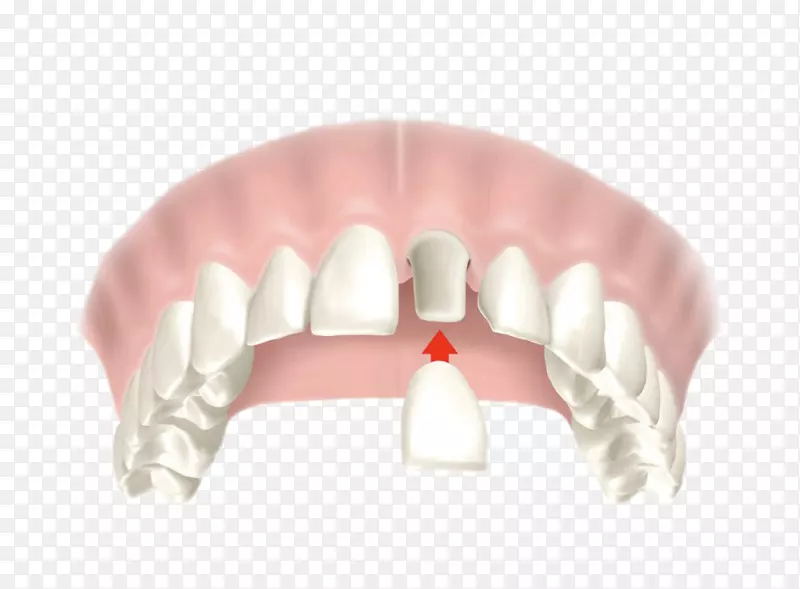 冠状牙科桥牙修复.龋齿