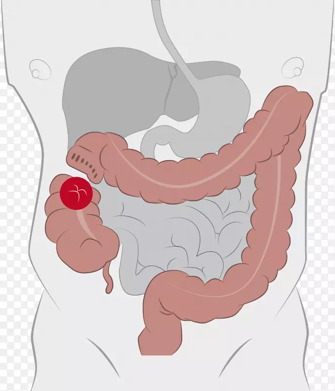 结肠造口术回肠造口造袋系统造口回肠肛管袋肠