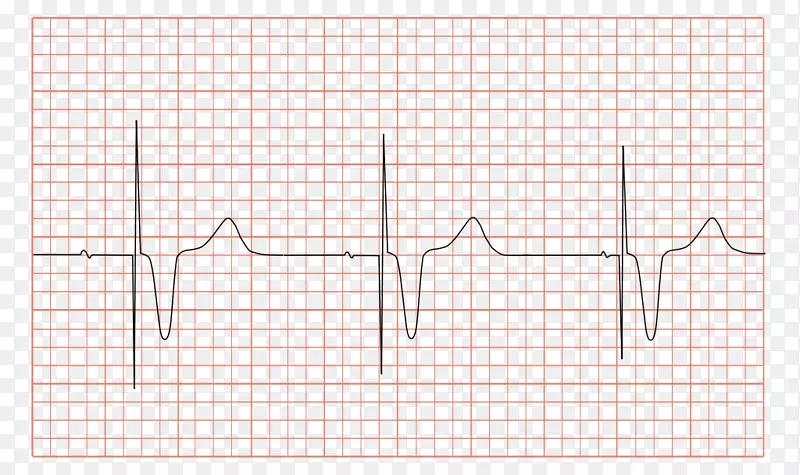 人工心脏起搏器心电图起搏器综合征多灶性房性心动过速药-心电图