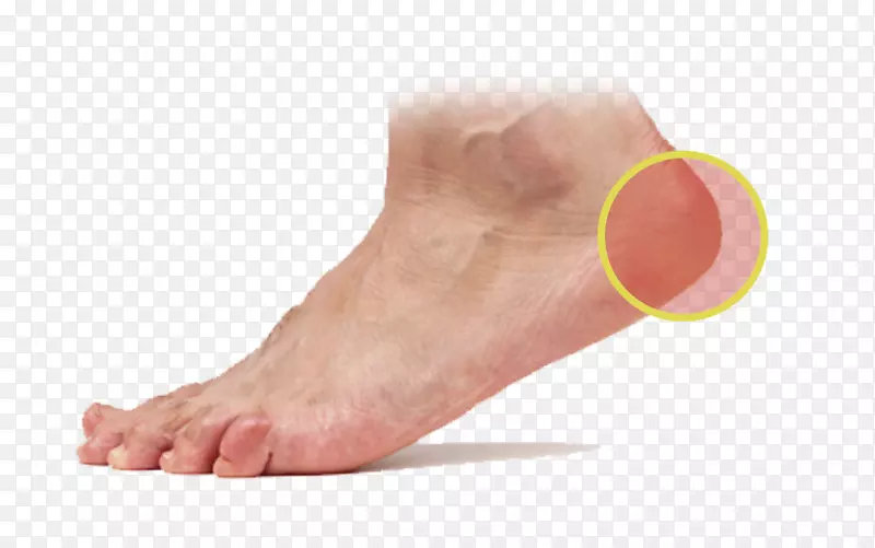 足底皮肤足底筋膜炎