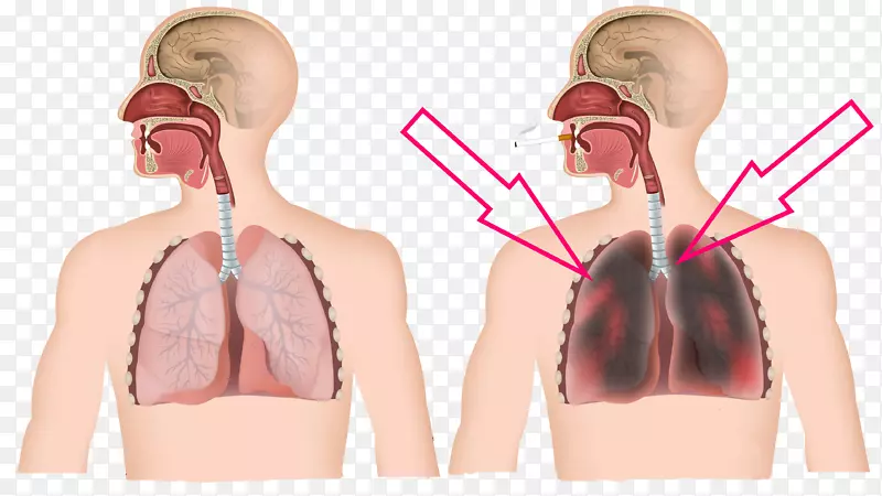 慢性阻塞性肺病吸烟肺心病呼吸困难