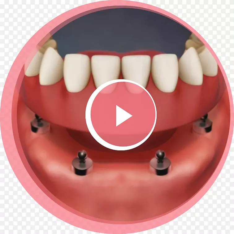 牙种植义齿，可摘局部义齿-种植义齿