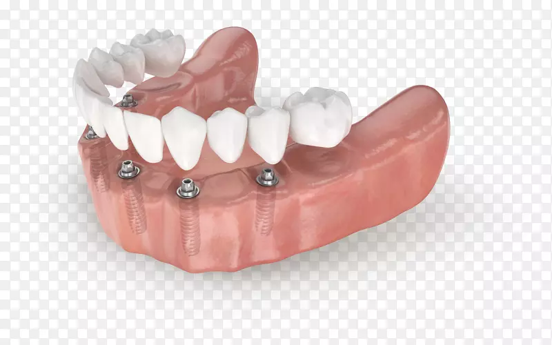 牙全对4牙种植牙科牙本质-种植牙