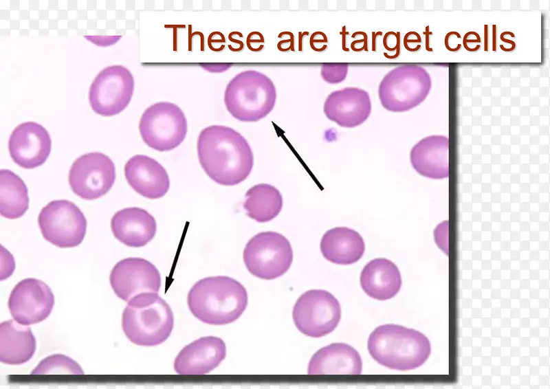 Codocyte红细胞膜红细胞增生症-海绵状细胞