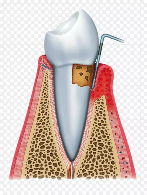 牙周病牙龈激光辅助新附着程序牙周病牙龈炎出血牙龈卡通