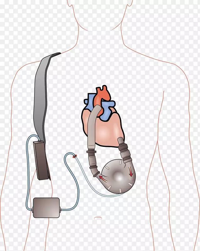 心室辅助装置人工心室心力衰竭-血流量