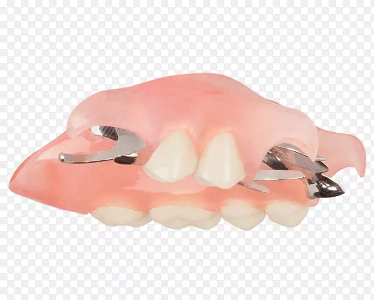 可摘局部义齿牙冠顶角