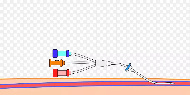 外周静脉导管中心静脉导管Seldinger技术动脉线
