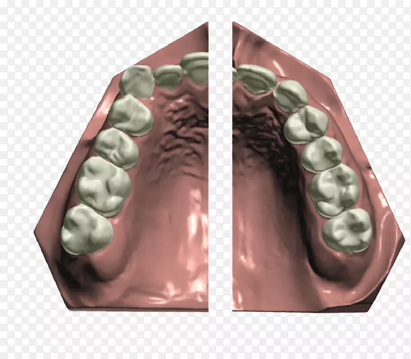 正畸学CAD/CAM牙科种植牙支架
