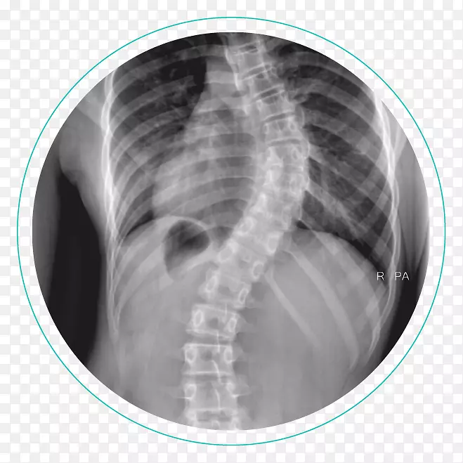 脊柱侧凸x线脊柱物理治疗Cobb角-肋骨笼