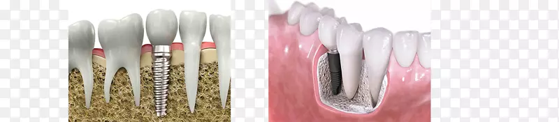 义齿修复学牙科种植牙健康