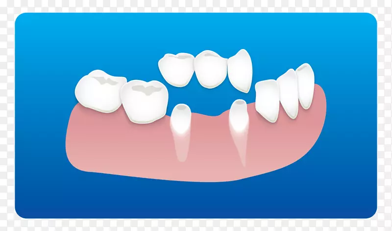 牙科牙种植体根管-牙科诊所卡