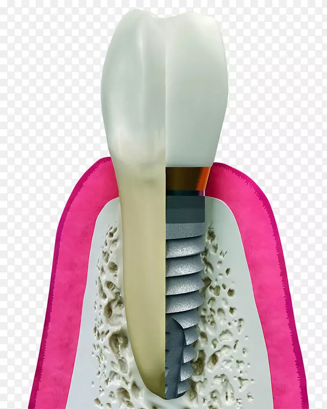 牙科种植体牙科手术.植入物