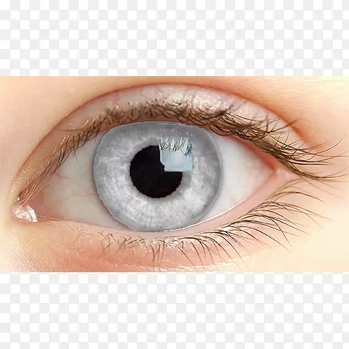 浅人眼虹膜视网膜