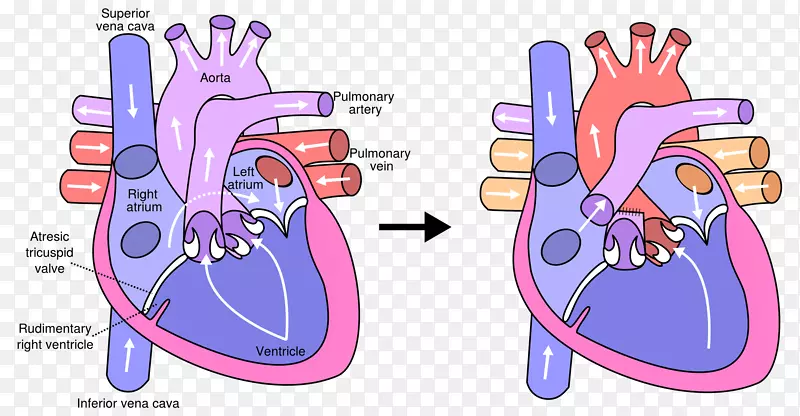 丰坦手术心脏手术三尖瓣闭锁肺动脉-新生儿