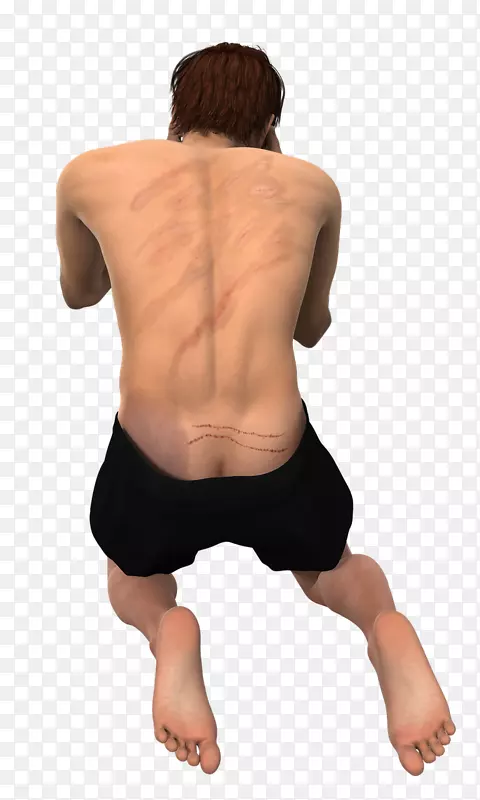 肌肉炎人类背部疾病治疗