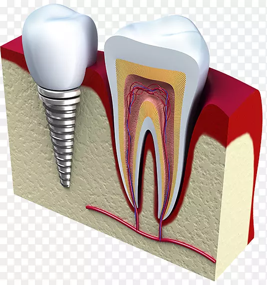 牙科植入物牙科手术