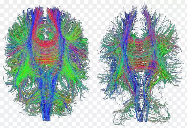 外伤性脑损伤扩散MRI阿尔茨海默病医学影像-脑