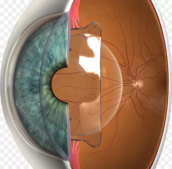 Phakic人工晶状体植入角膜磨镶镜LASIK视力-眼睛