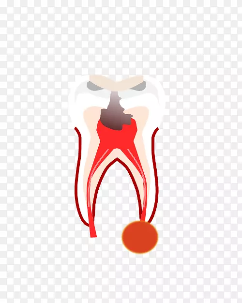 牙科根管冠义齿.牙冠