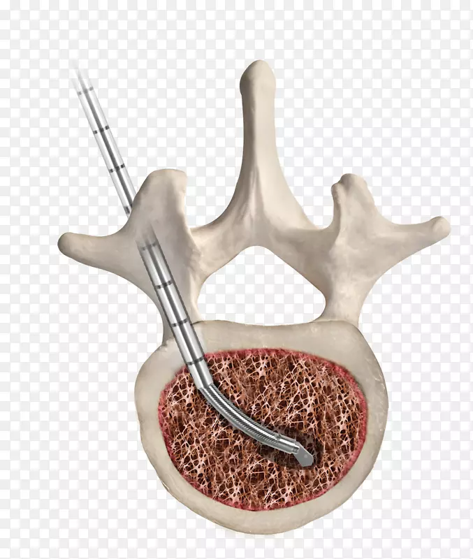 胸椎人脊柱经皮椎体成形术
