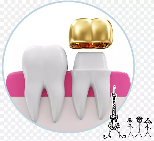 牙冠牙科修复牙种植体冠