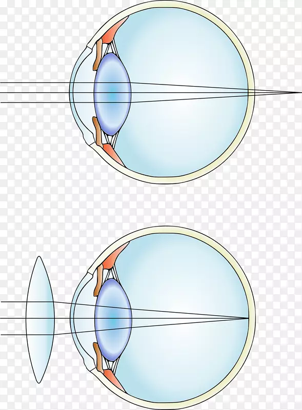 近视矫正性晶状体远视隐形眼镜.眼睛