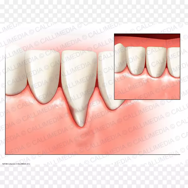 牙龈手术牙周病牙龈退缩-健康