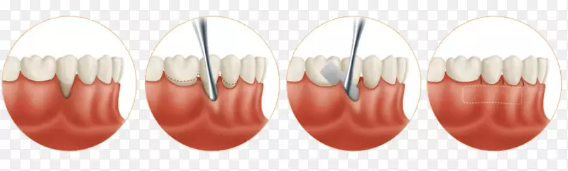 牙龈移植物牙龈软组织牙龈退缩