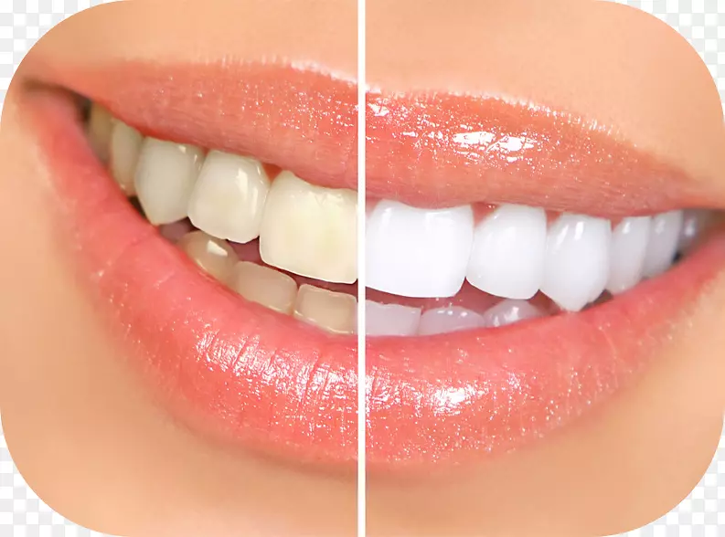 牙齿美白-人类牙齿