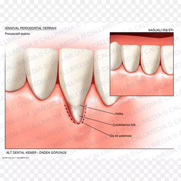 牙龈退缩手术牙周病-健康