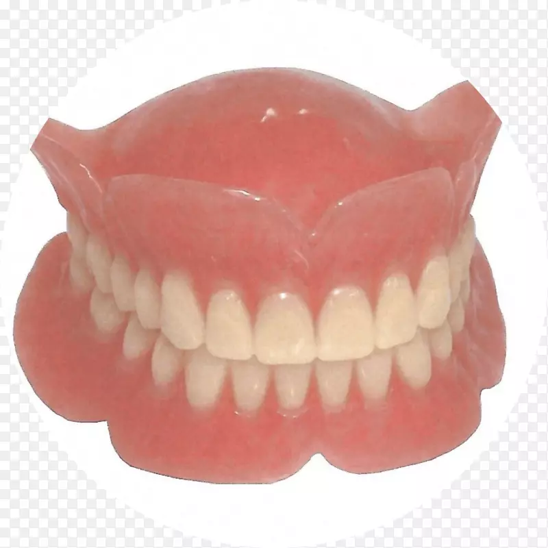 牙科可摘局部义齿种植体.桥