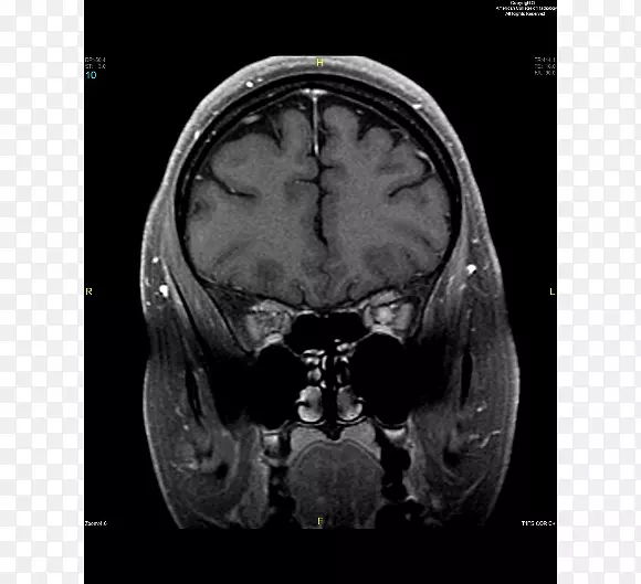 颅骨医学X线摄影CT医学脑-颅骨