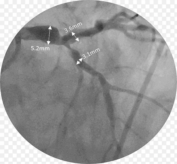 支架置入术冠状动脉支架心脏病并发症自膨胀金属支架