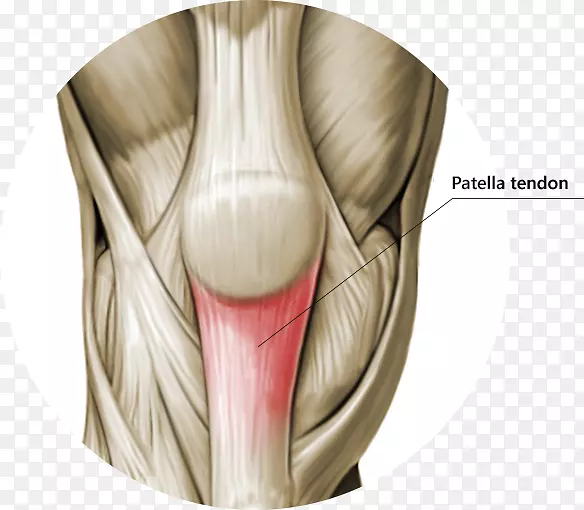 膝关节髌腱炎肌腱髌韧带