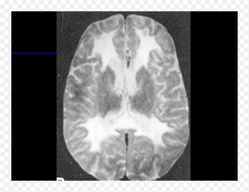 计算机断层扫描l ketieteellinen r ntgenkuvaus x射线脑X线摄影-大脑