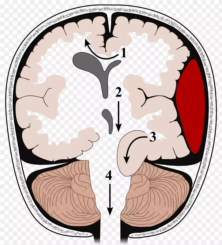 脑疝，颅内压，创伤性脑损伤，克诺汉氏切口-脑