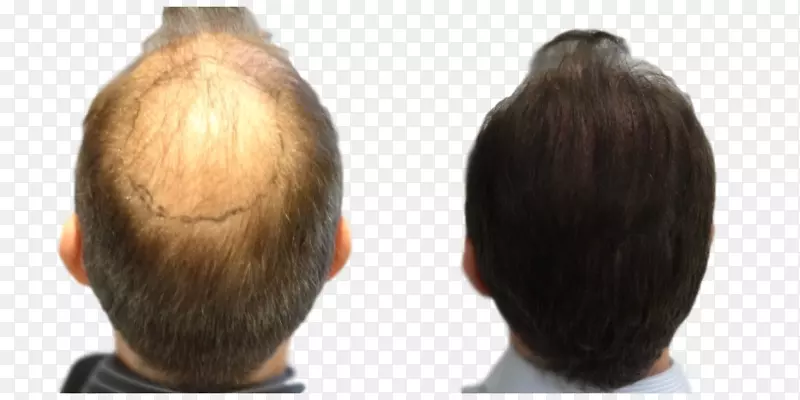 毛发移植毛囊单位提取步骤剪长发